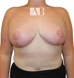 After breast reduction surgery