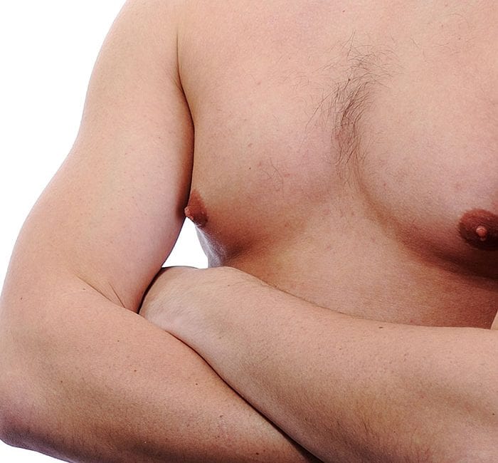 Gynaecomastia – Male Breasts – Man Boobs