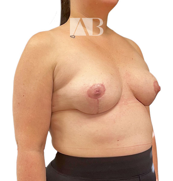 Anca Breahna Tuberous Breast Correction - P1_Tuberous_Breast_AB_21824_45_After