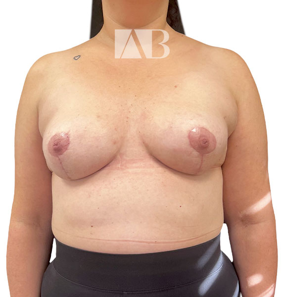 Anca Breahna Tuberous Breast Correction - P1_Tuberous_Breast_AB_21824_Front_After