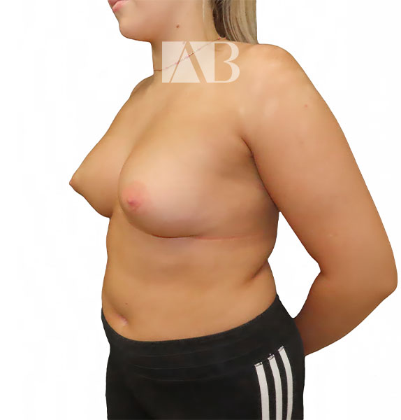 Anca Breahna Tuberous Breast Correction - P2_Tuberous_Breast_AB_21824_45_After