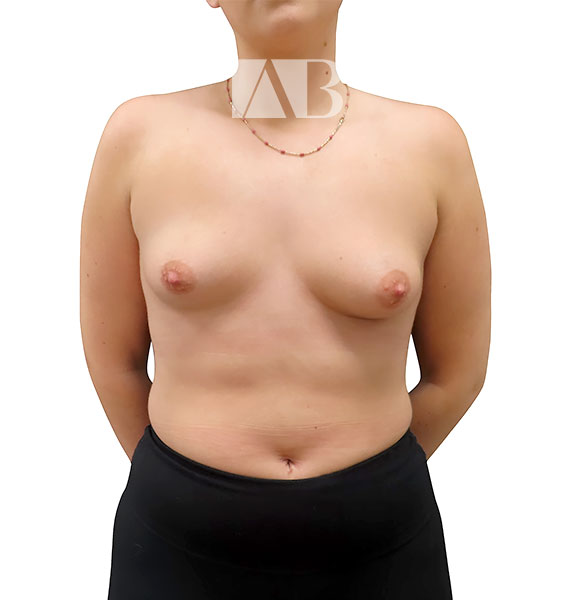 Anca Breahna Tuberous Breast Correction - P2_Tuberous_Breast_AB_21824_Front_Before