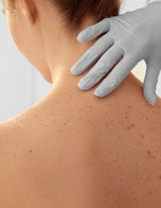 Skin surgery Cheshire for skin concerns
