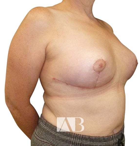 Breast Uplift (Mastopexy) in Chester