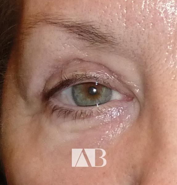 Eyelid Ptosis Surgery in Chester UK by Anca Breahna