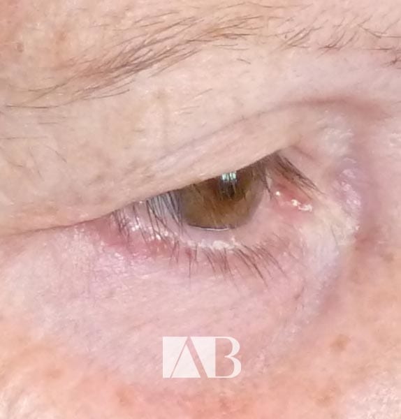 Eyelid Ptosis Surgery by Anca Breahna