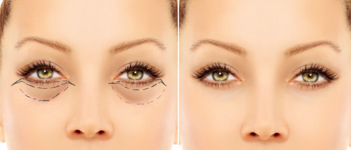 Eyelid surgery recovery timeline