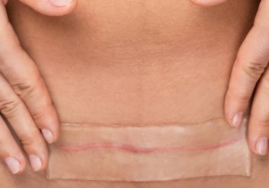 Silicone Strips for Plastic Surgery Scars