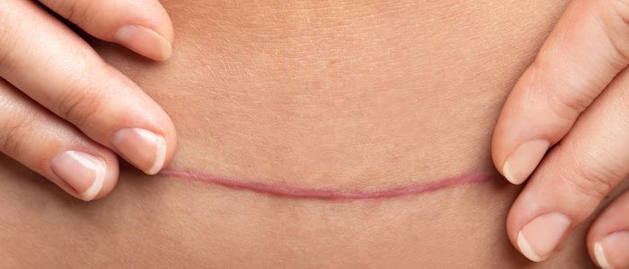 Getting a Tummy tuck after C section