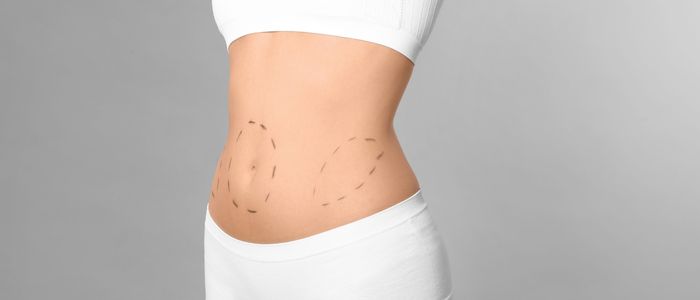 Liposuction vs tummy tuck which is best