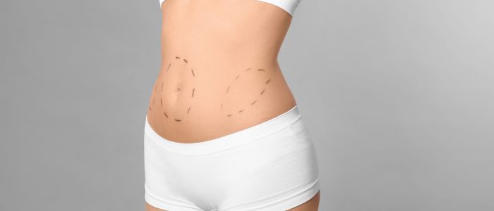 Liposuction to get rid of belly fat