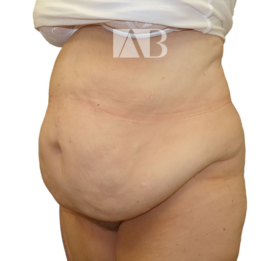 Anca Breahna Abdominoplasty Photos - P1_Abdominoplasty_AB_21824_45_Before