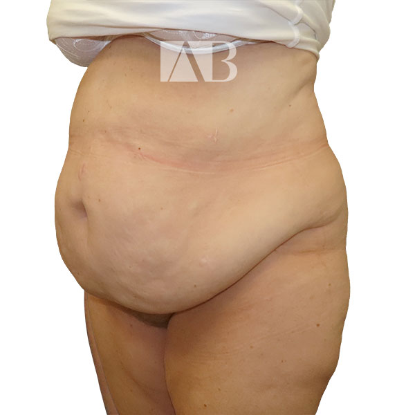 Anca Breahna Abdominoplasty Photos - P1_Abdominoplasty_AB_21824_45_Before