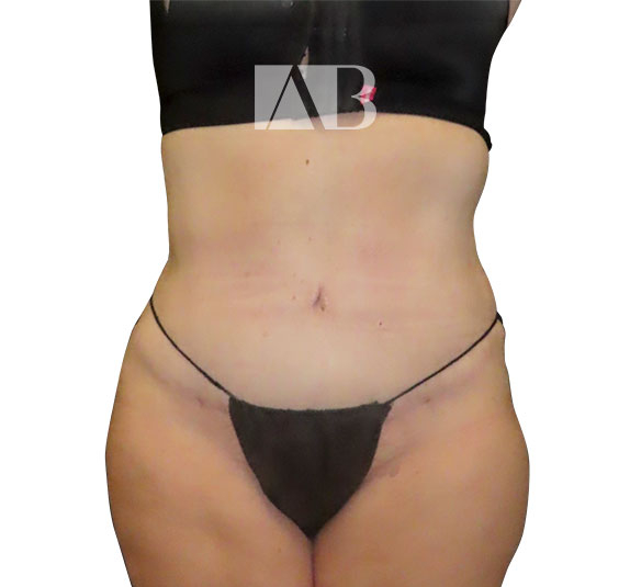 Anca Breahna Abdominoplasty Photos - P1_Abdominoplasty_AB_21824_Front_After