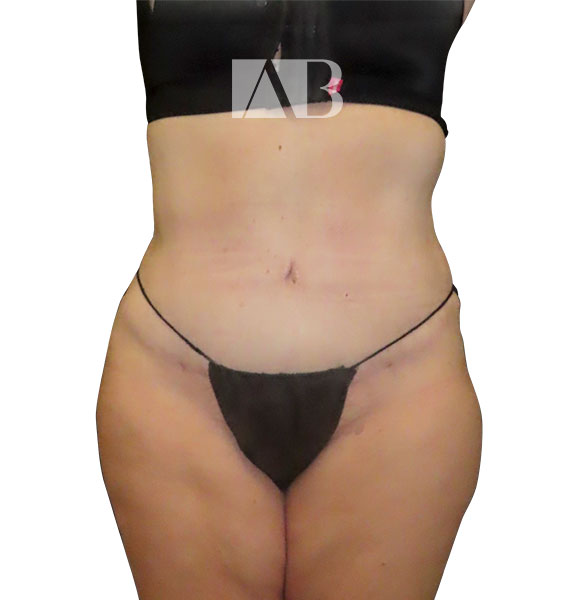 Anca Breahna Abdominoplasty Photos - P1_Abdominoplasty_AB_21824_Front_After