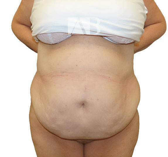 Anca Breahna Abdominoplasty Photos - P1_Abdominoplasty_AB_21824_Front_Before