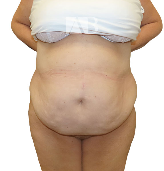 Anca Breahna Abdominoplasty Photos - P1_Abdominoplasty_AB_21824_Front_Before