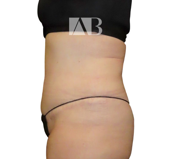 Anca Breahna Abdominoplasty Photos - P1_Abdominoplasty_AB_21824_Side_After