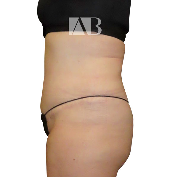 Anca Breahna Abdominoplasty Photos - P1_Abdominoplasty_AB_21824_Side_After