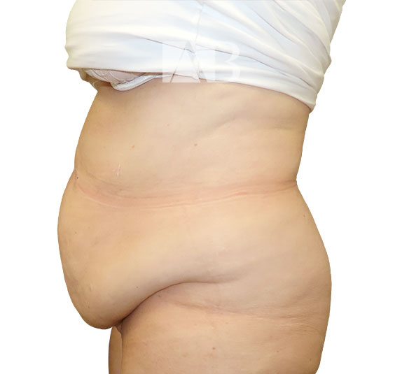 Anca Breahna Abdominoplasty Photos - P1_Abdominoplasty_AB_21824_Side_Before
