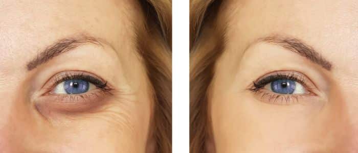 Causes and Treatment for Eyelid Ptosis