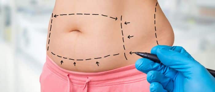Liposuction to get rid of excess fat