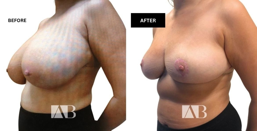 Breast Reduction Before and After Photo – Patient 17 – 45 degree