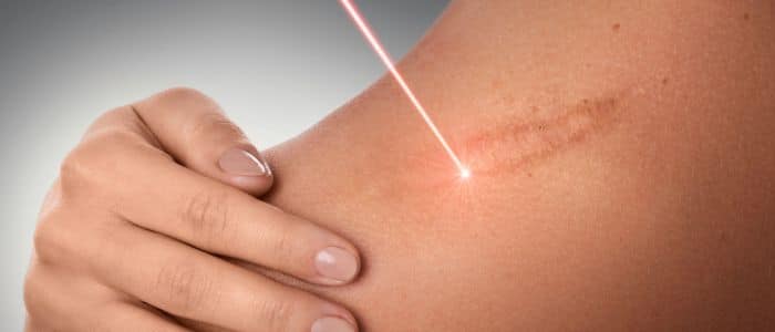 Laser for scar removal