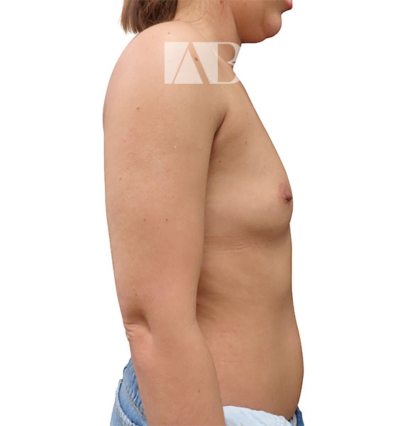 Anca Breahna Bilateral Breast Augmentation - P1_Bilateral-Breast-Augmentation_AB_21824_Side_Before