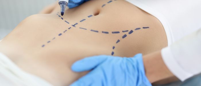 Candidates for abdominoplasty for FUPA