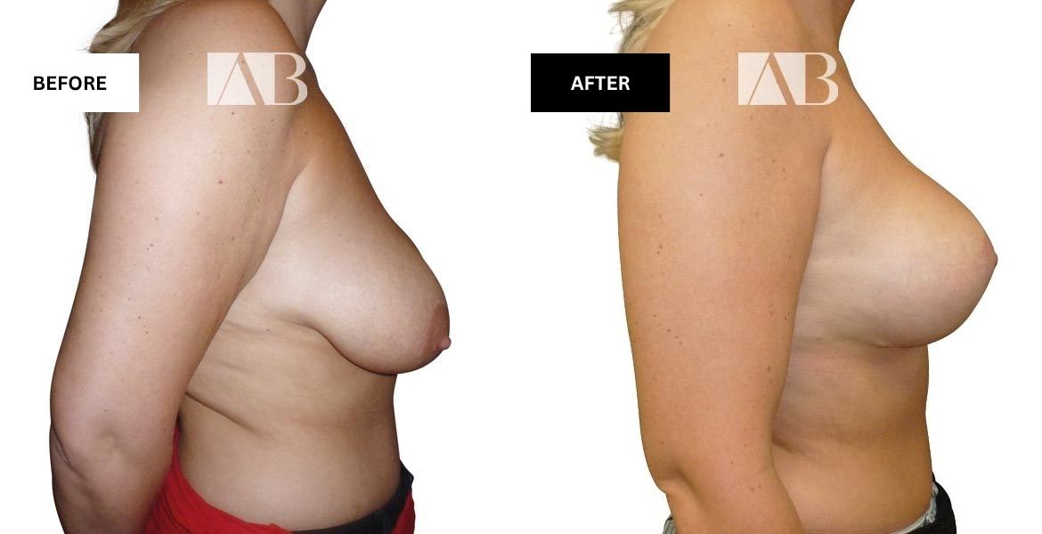 Breast Asymmetry Before and After Photo - Right Side