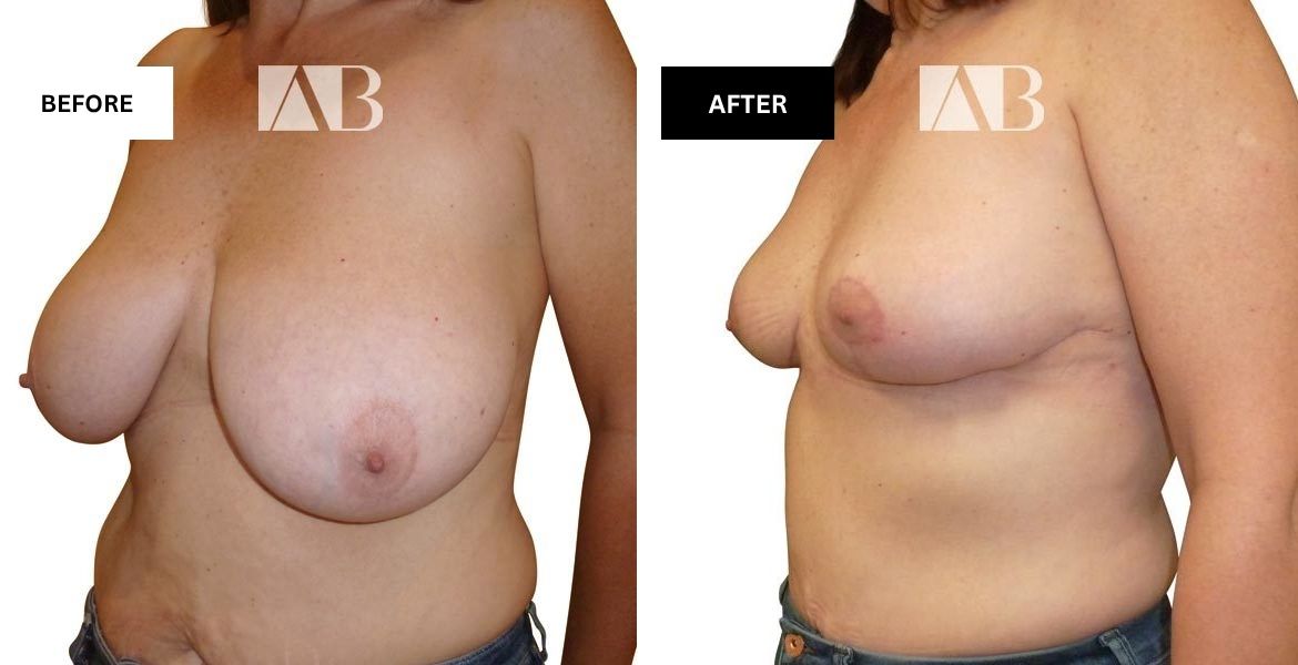 Breast Reduction Before and After Photo – Patient 10 – 45 degree