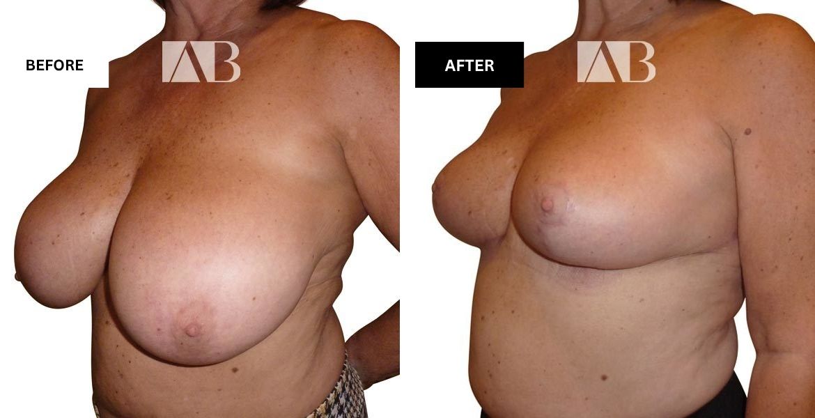 Breast Reduction Before and After Photo – Patient 11 – 45 degree