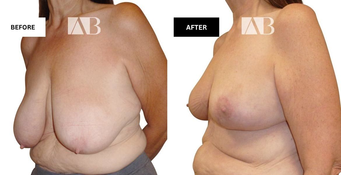 Breast Reduction Before and After Photo – Patient 12 – 45 degree