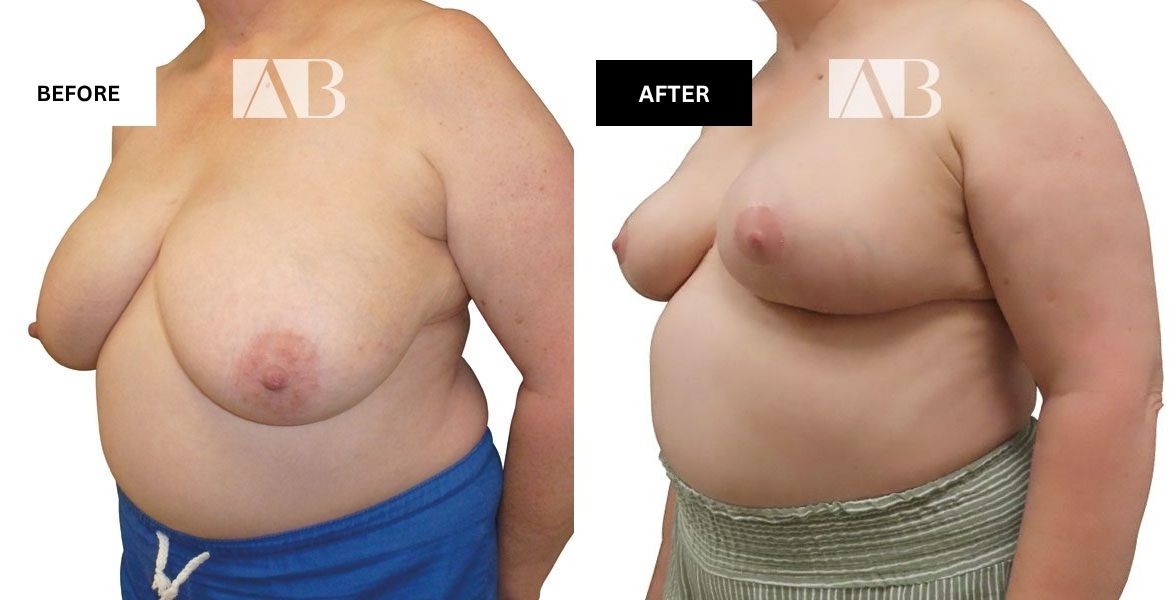Breast Reduction Before and After Photo – Patient 8 – 45 degree