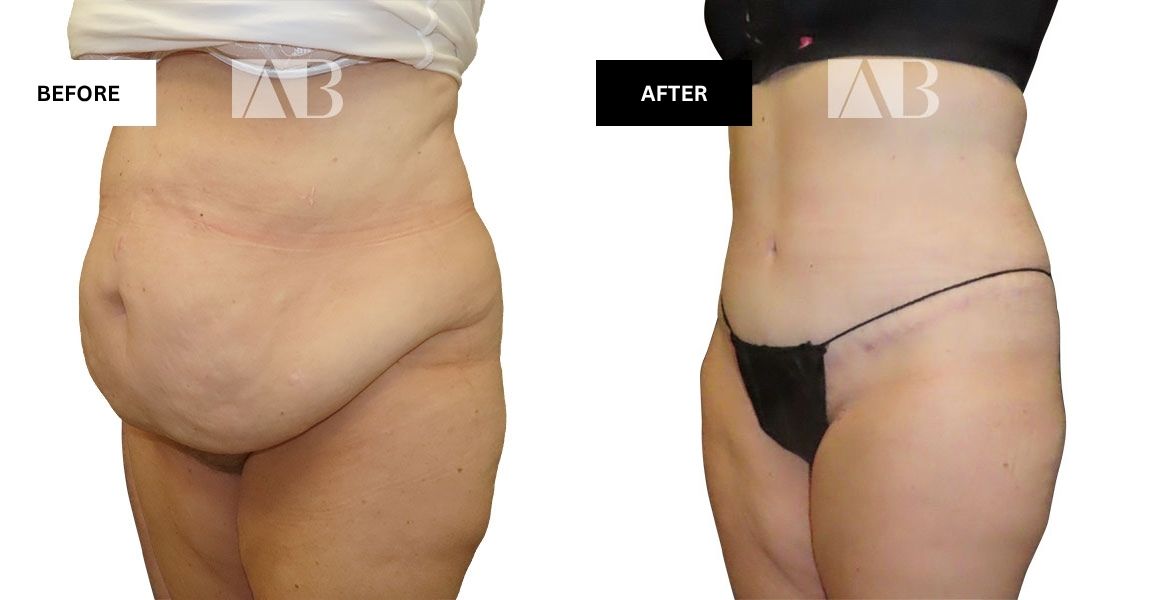 Tummy Tuck Before and After Photo Patient 1 - 45 degree