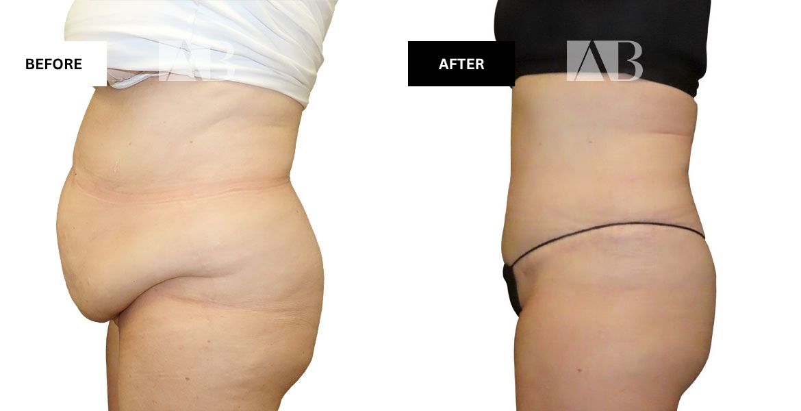 Tummy Tuck Before and After Photo Patient 1 - Left Side
