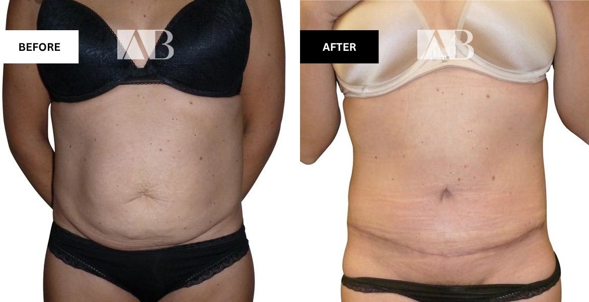 Tummy Tuck Before and After Patient 10 - Front View