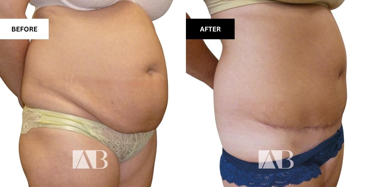 Tummy Tuck Before and After Patient 11 - 45 degree