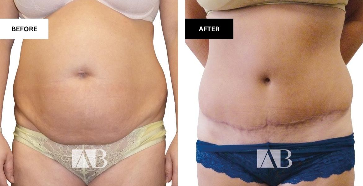 Tummy Tuck Before and After Patient 11 - Front View