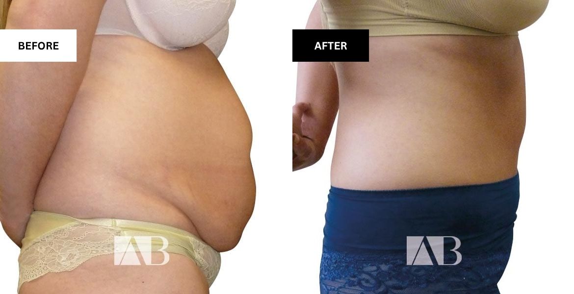 Tummy Tuck Before and After Patient 11 - Right Side
