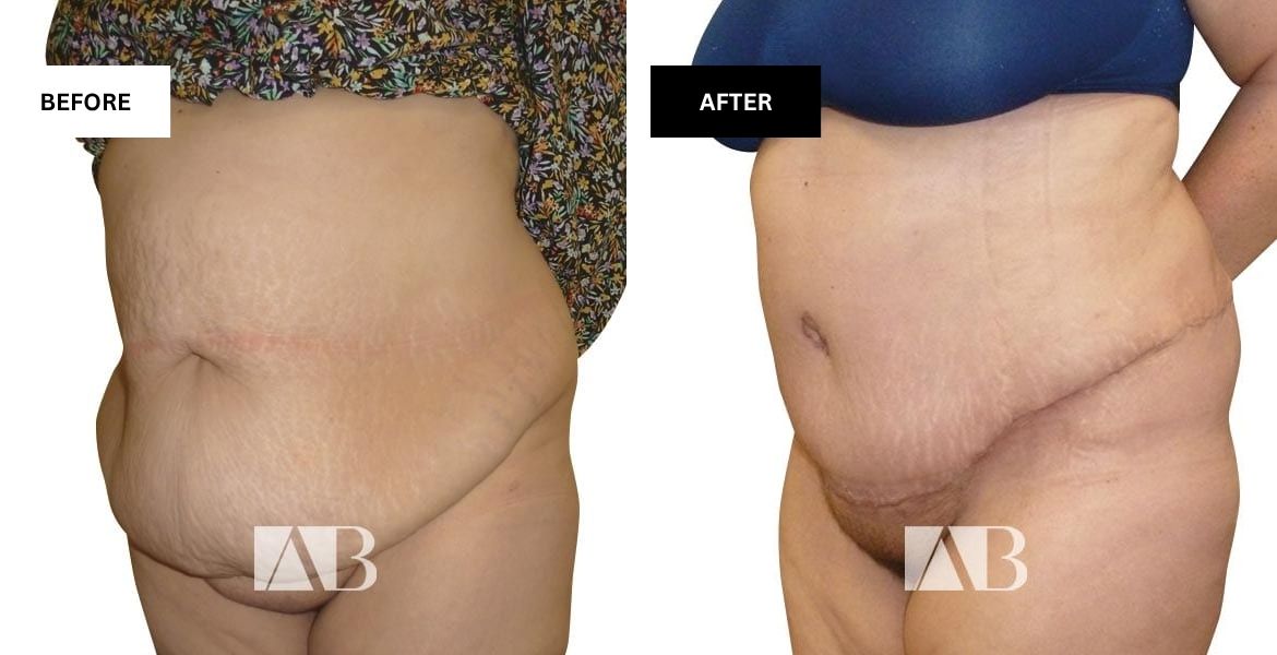 Tummy Tuck Before and After Photo Patient 12 - 45 degree