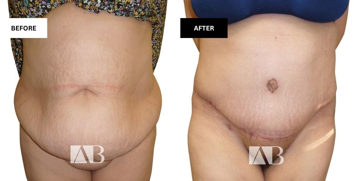 Tummy Tuck Before and After Photo Patient 12 - Front View