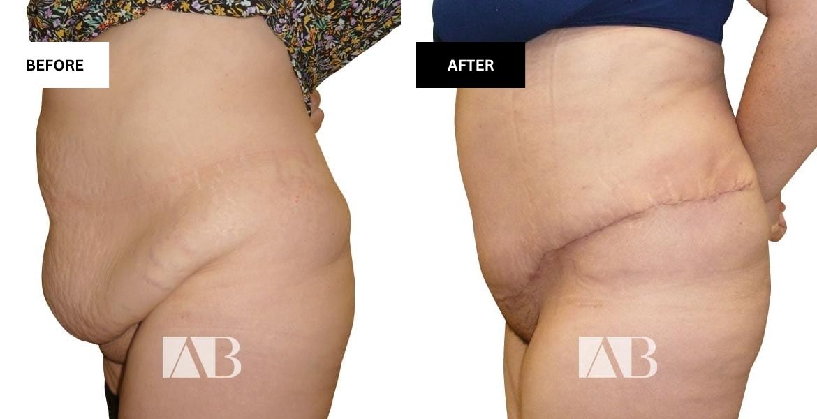 Tummy Tuck Before and After Patient 12 - Left Side