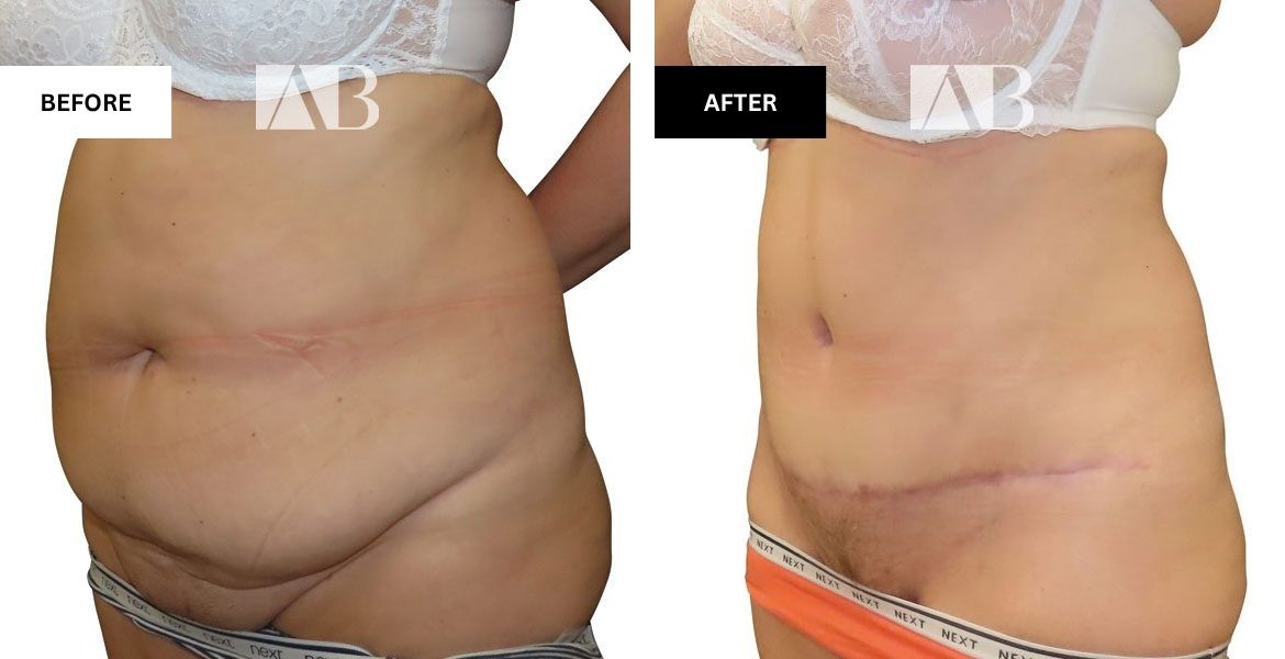 Tummy Tuck Before and After Photo Patient 2 -  45 degree