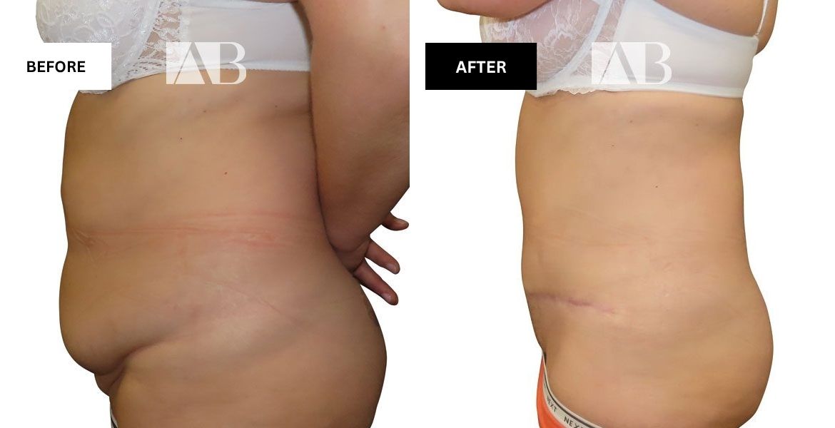 Tummy Tuck Before and After Photo Patient 2 - Left Side