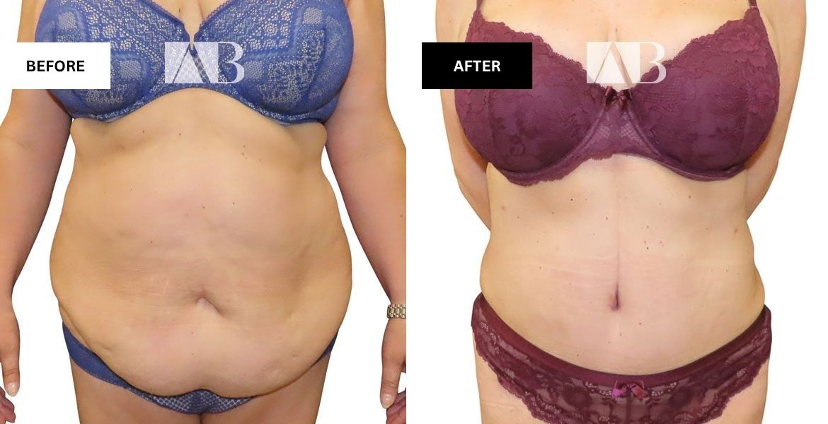 Tummy Tuck Before and After Photo Patient 3 - Front View