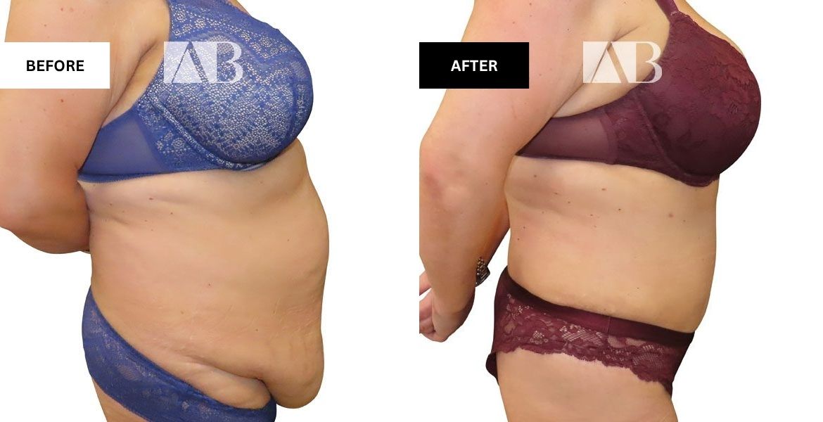 Tummy Tuck Before and After Photo Patient 3 - Right Side
