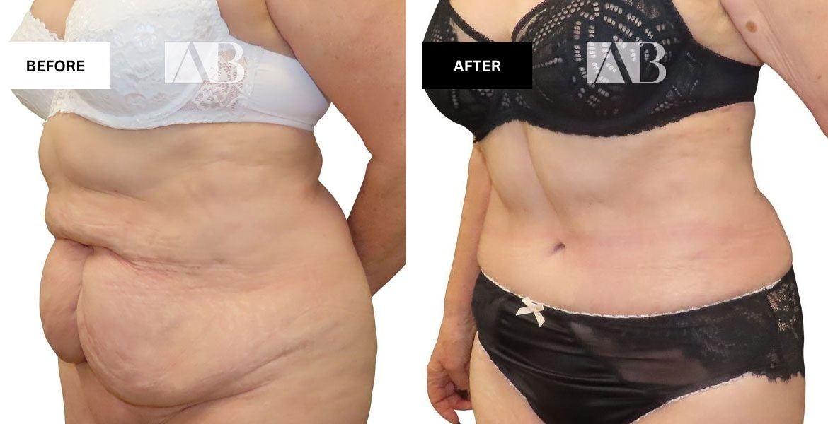 Tummy Tuck Before and After Photo Patient 4 - 45 degree