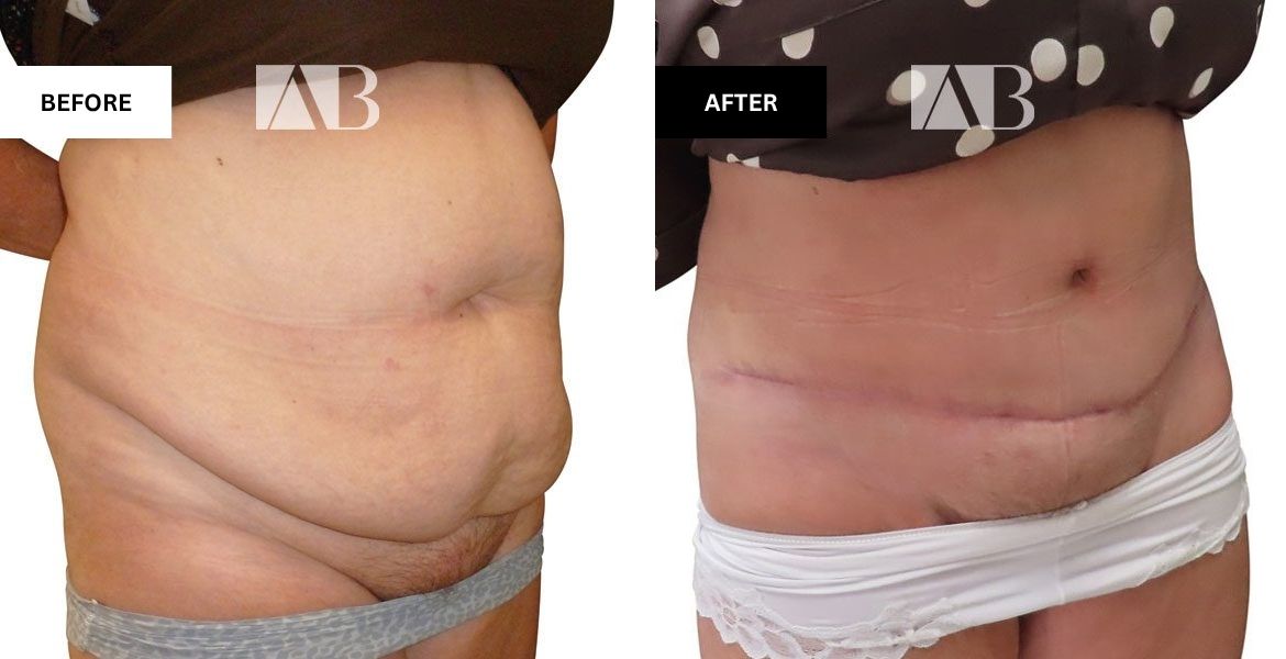 Tummy Tuck Before and After Photo Patient 5 - 45 degree